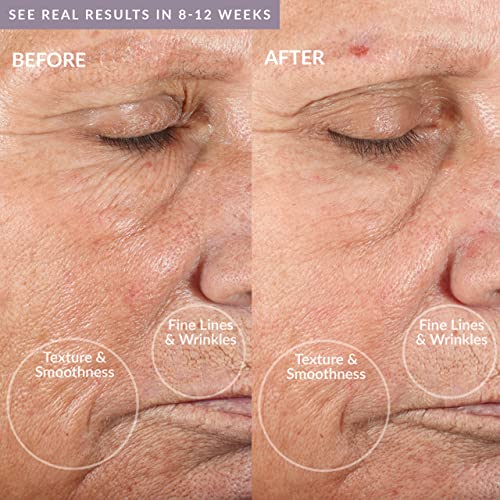 PMD Personal Microderm Classic - At-Home Microdermabrasion Machine with Kit for Face & Body - Exfoliating Crystals and Vacuum Suction for Fresh and Radiant Skin